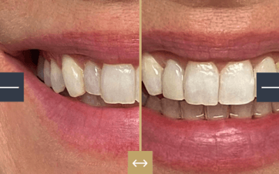 Are Your Dental Fillings Falling Out? Book an Appointment with an Emergency Dentist